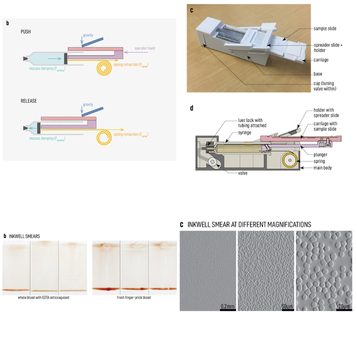Graphical abstract for Inkwell: Design and validation of a low-cost open electricity-free 3D printed device for automated thin smearing of whole blood