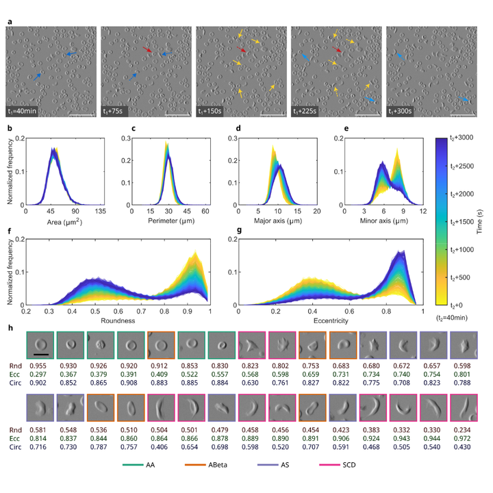 Graphical abstract for Morphology-based classification of sickle cell disease and β-thalassemia using a low-cost automated microscope and machine learning